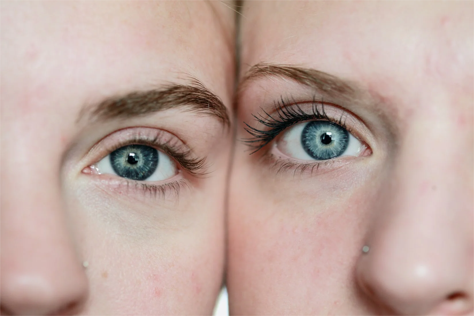 Role of levulinic acid(LA) in skin treatment